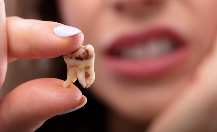 C&aacute;rie ainda &eacute; a principal causa de perda de dentes no Brasil, aponta levantamento