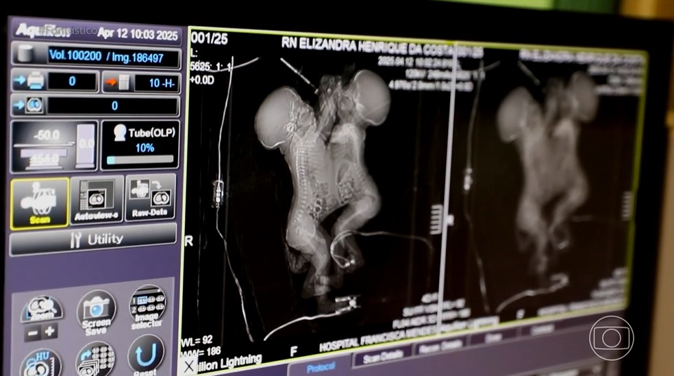 M&atilde;e de g&ecirc;meas siamesas retorna para casa ap&oacute;s viagem de 670 km e cirurgia in&eacute;dita de separa&ccedil;&atilde;o