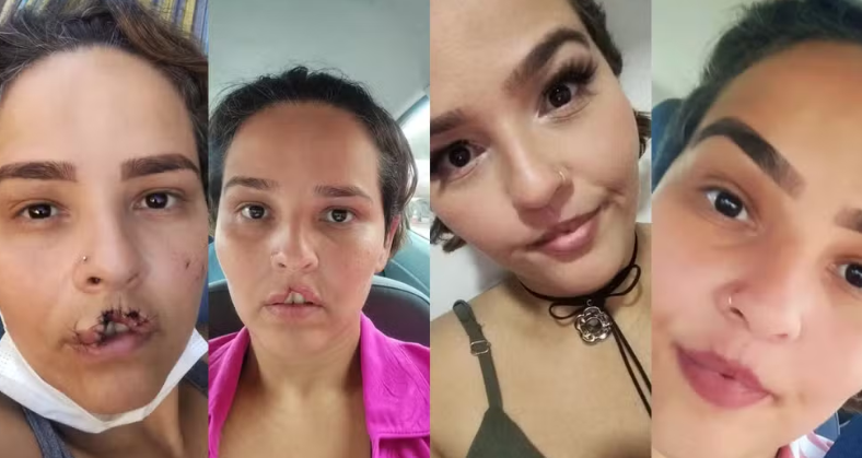 Ap&oacute;s ter l&aacute;bio arrancado por cachorro, mulher passa por cirurgia gratuita e retoma autoestima em SC