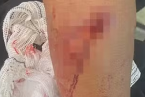 Mulher &eacute; atacada por matilha de c&atilde;es em Ceil&acirc;ndia e fica ferida