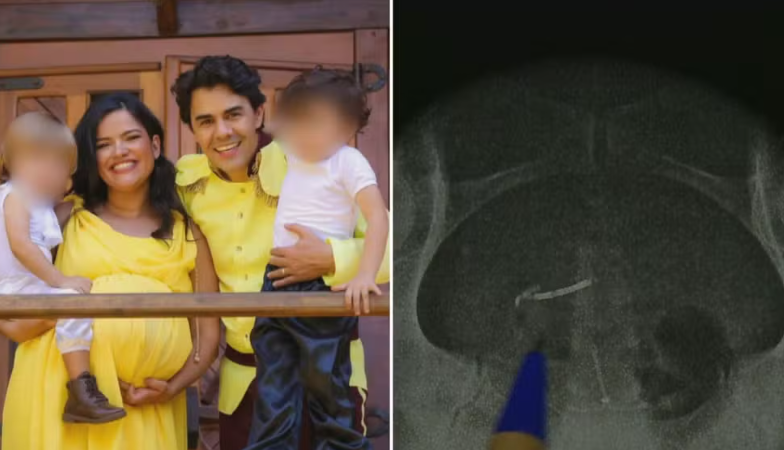 Mulher engravida com DIU e descobre 3 anos depois que o dispositivo perfurou seu &uacute;tero e intestino
