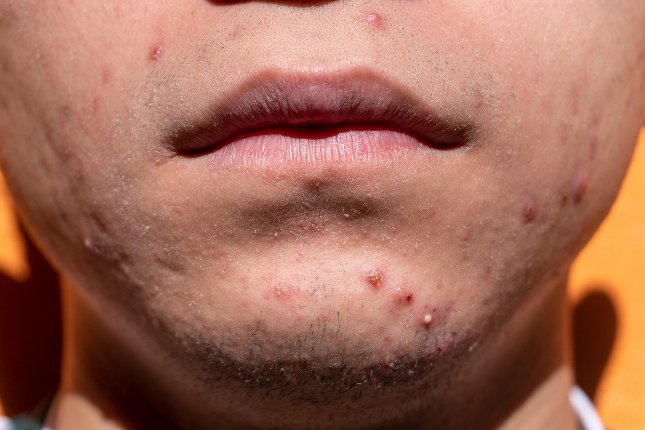 O segredo sobre sua acne que seu dermatologista n&atilde;o est&aacute; te contando