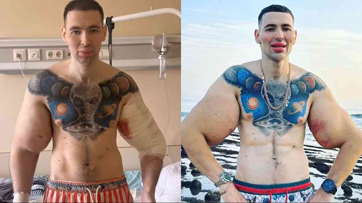 &ldquo;Popeye russo&rdquo; corre risco de amputa&ccedil;&atilde;o ap&oacute;s infec&ccedil;&atilde;o grave por uso de Synthol