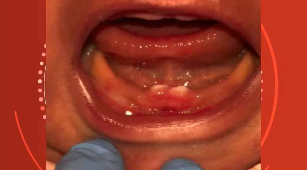 Beb&ecirc; nasce com dentes e precisa de cirurgia nos primeiros dias de vida em Cacoal RO