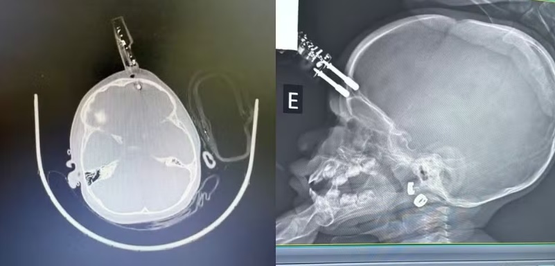 Beb&ecirc; de 1 ano cai da cama e fica com carregador cravado na testa; imagem &eacute; forte