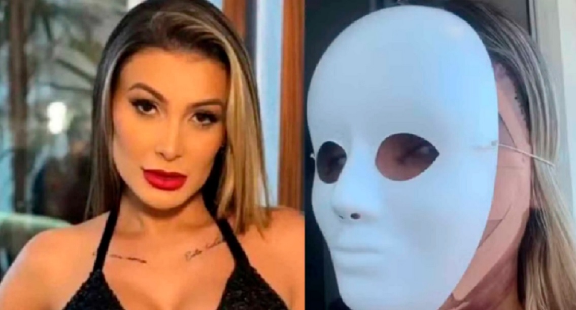 Andressa Urach aparece irreconhec&iacute;vel ap&oacute;s cirurgia no rosto e surpreende f&atilde;s
