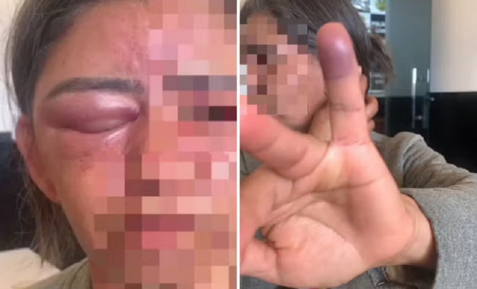 Mulher espancada ap&oacute;s sumi&ccedil;o de chave sofreu &ldquo;extrema viol&ecirc;ncia&rdquo;, aponta laudo da pol&iacute;cia