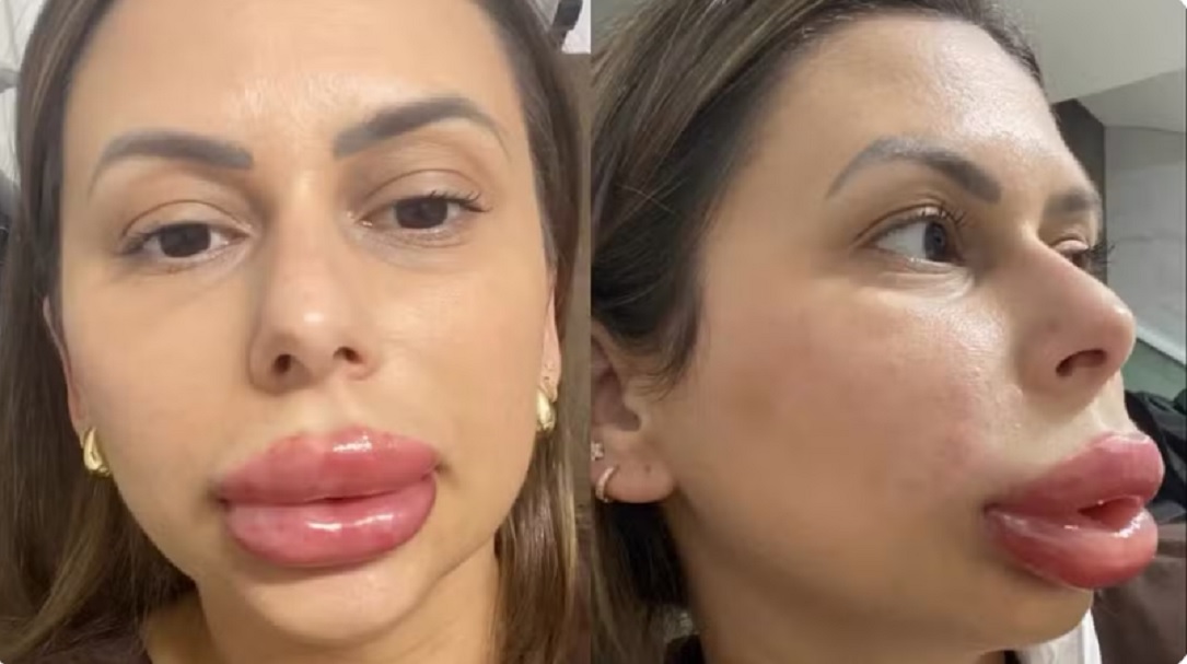 Mulher viraliza ao mostrar rea&ccedil;&atilde;o inesperada ap&oacute;s preenchimento labial: “Assustei todo mundo”