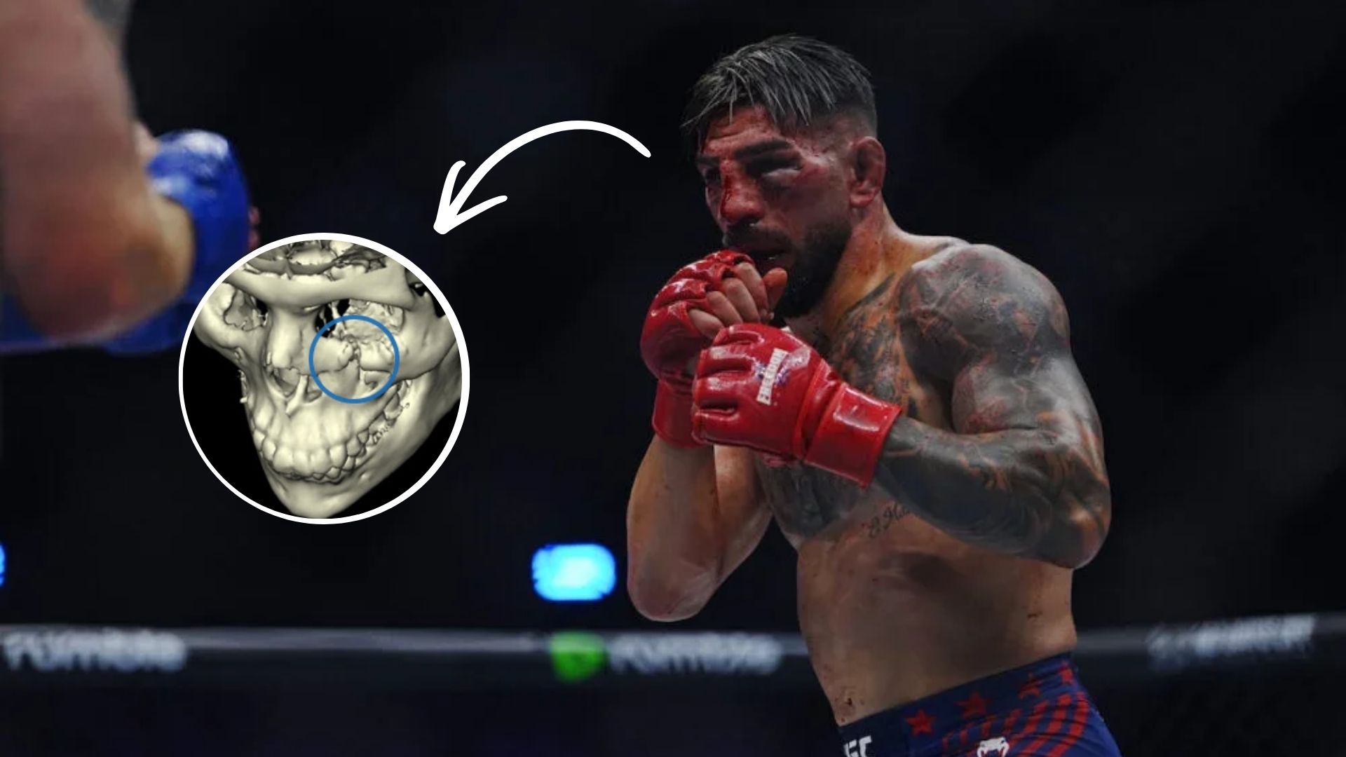 Topuria recebe alta ap&oacute;s ficar desfigurado no UFC Casa Branca; veja boletim m&eacute;dico