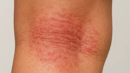Coceira intensa no inverno pode indicar dermatite at&oacute;pica e exigir tratamento