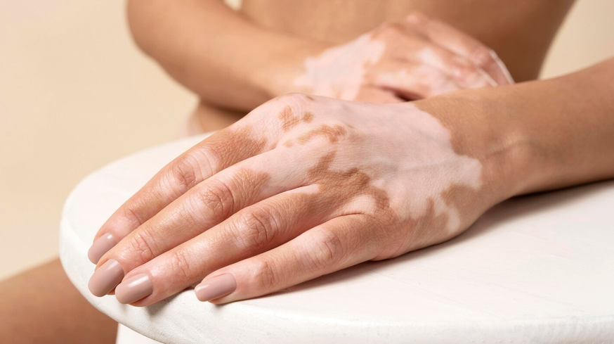 Vitiligo: diagn&oacute;stico precoce e tratamento ajudam a controlar a doen&ccedil;a e melhorar a qualidade de vida