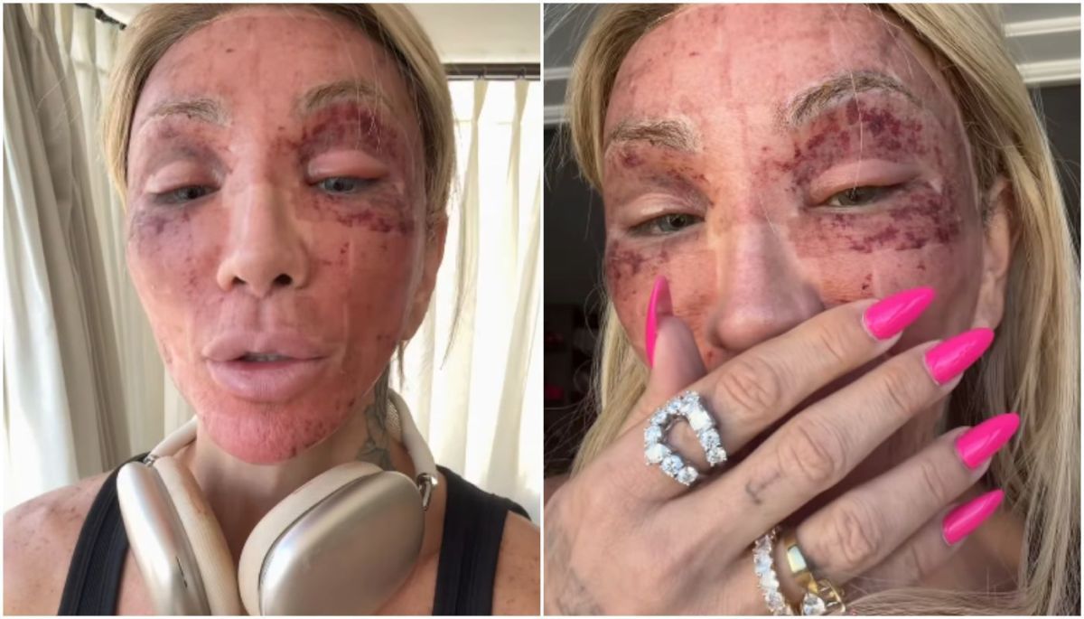 Maya Massafera mostra rosto inchado ap&oacute;s peeling e explica procedimento est&eacute;tico